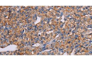 Immunohistochemistry of paraffin-embedded Human prostate cancer tissue using GHITM Polyclonal Antibody at dilution 1:30 (GHITM anticorps)