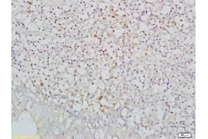 Formalin-fixed and paraffin embedded human nasopharyngeal carcinoma labeled with Anti-NKG2D/CD314/KLRK1 Polyclonal Antibody, Unconjugated  at 1:200, followed by conjugation to the secondary antibody and DAB staining (KLRK1 anticorps  (AA 121-219))