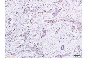 Formalin-fixed and paraffin embedded human tumor tissue labeled with Anti-HPV16-E6 Polyclonal Antibody, Unconjugated at 1:200, followed by conjugation to the secondary antibody and DAB staining (Humain Papilloma Virus 16 E6 (HPV-16 E6) (AA 85-158) anticorps)