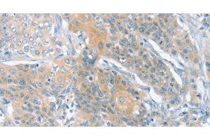 Immunohistochemistry of paraffin-embedded Human cervical cancer using SLIT2 Polyclonal Antibody at dilution of 1:30 (SLIT2 anticorps)