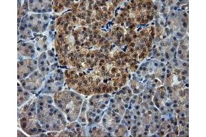 Immunohistochemical staining of paraffin-embedded Adenocarcinoma of ovary tissue using anti-RC201933 mouse monoclonal antibody. (PIM2 anticorps)