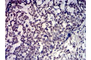 Immunohistochemical analysis of paraffin-embedded esophageal cancer tissues using TBP mouse mAb with DAB staining. (TBP anticorps  (AA 1-144))