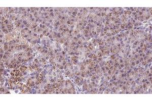 ABIN6273254 at 1/100 staining Human pancreas cancer tissue by IHC-P. (HBS1L anticorps  (N-Term))