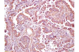 Formalin-fixed and paraffin embedded human lung carcinoma labeled with Anti-phospho-PIK3C3(Ser282) Polyclonal Antibody, Unconjugated (ABIN711656) at 1:200 followed by conjugation to the secondary antibody and DAB staining
