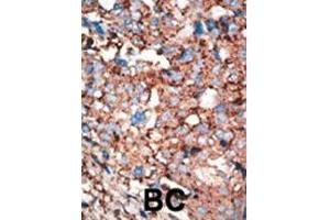 Formalin-fixed and paraffin-embedded human cancer tissue reacted with the primary antibody, which was peroxidase-conjugated to the secondary antibody, followed by AEC staining.