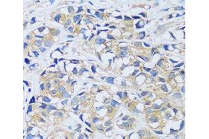 Immunohistochemistry of paraffin-embedded Human breast cancer using CABP7 Polyclonal Antibody at dilution of 1:100 (40x lens). (CABP7 anticorps)