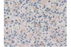 IHC-P analysis of Human Prostate Gland Cancer Tissue, with DAB staining. (TOR1A anticorps  (AA 33-321))