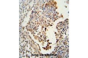 CADM1 antibody (N-term) immunohistochemistry analysis in formalin fixed and paraffin embedded human lung carcinoma followed by peroxidase conjugation of the secondary antibody and DAB staining. (CADM1 anticorps  (N-Term))