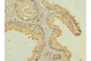 Immunohistochemistry of paraffin-embedded human prostate cancer using ABIN7142631 at dilution of 1:100