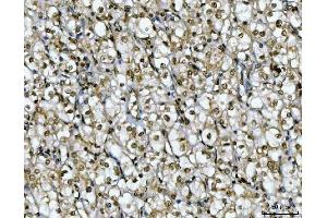 IHC analysis of Ki67/MKI67 using anti-Ki67/MKI67 antibody (ABIN7601873). (Ki-67 anticorps  (AA 5-2358))