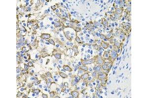 Immunohistochemistry of paraffin-embedded Human esophageal cancer using ACVR2A Polyclonal Antibody at dilution of 1:100 (40x lens). (ACVR2A anticorps)