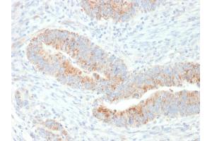 Formalin-fixed, paraffin-embedded human Colon Carcinoma stained with Erythropoietin (EPO) Mouse Monoclonal Antibody (EPO/1367). (EPO anticorps  (AA 28-162))
