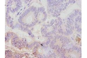 Immunohistochemistry of paraffin-embedded human colon cancer using ABIN7179111 at dilution of 1:100 (AVPR1A anticorps  (AA 7-52))