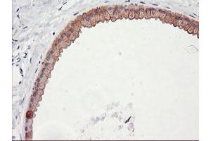 Immunohistochemical staining of paraffin-embedded Human breast tissue using anti-DGKA mouse monoclonal antibody. (DGKA anticorps)