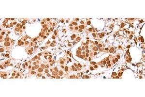 Immunohistochemistry of paraffin-embedded Human breast cancer tissue using RCOR3 Polyclonal Antibody at dilution of 1:60(x200) (RCOR3 anticorps)