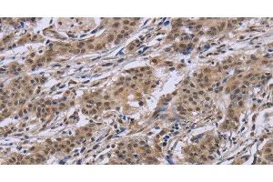 Immunohistochemistry of paraffin-embedded Human gastric cancer tissue using IPO8 Polyclonal Antibody at dilution 1:50 (Importin 8 anticorps)