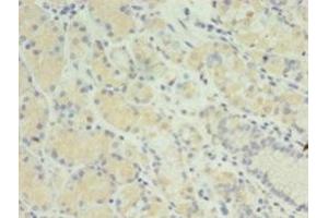 Immunohistochemistry of paraffin-embedded human gastric cancer using ABIN7165811 at dilution of 1:100 (MIS12 anticorps  (AA 1-305))