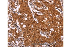 Immunohistochemistry of Human gastric cancer using APMAP Polyclonal Antibody at dilution of 1:30