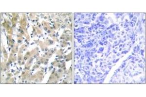 Immunohistochemistry analysis of paraffin-embedded human liver carcinoma tissue, using THRB Antibody.