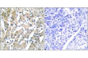 Immunohistochemistry analysis of paraffin-embedded human liver carcinoma tissue, using THRB Antibody. (THRB anticorps  (AA 391-440))