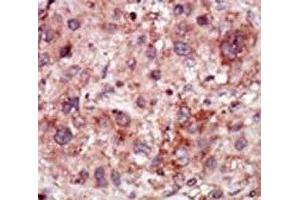 IHC analysis of FFPE human hepatocarcinoma stained with the GAK antibody (GAK anticorps  (AA 15-45))