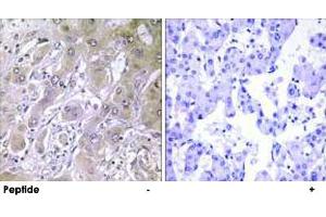 Immunohistochemistry analysis of paraffin-embedded human liver carcinoma tissue using ACOT12 polyclonal antibody . (ACOT12 anticorps)