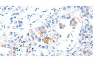 Immunohistochemistry of paraffin-embedded Human lung cancer tissue using MUC3A Polyclonal Antibody at dilution 1:60 (MUC3A anticorps)