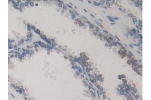 Detection of MAPKAPK2 in Human Prostate Tissue using Polyclonal Antibody to MAP Kinase Activated Protein Kinase 2 (MAPKAPK2) (MAPKAP Kinase 2 anticorps  (AA 139-367))