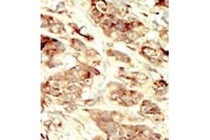 Formalin-fixed and paraffin-embedded human cancer tissue 8breast carcinoma) reacted with the primary antibody, which was peroxidase-conjugated to the secondary antibody, followed by DAB staining.