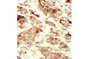 Formalin-fixed and paraffin-embedded human cancer tissue 8breast carcinoma) reacted with the primary antibody, which was peroxidase-conjugated to the secondary antibody, followed by DAB staining. (STK35 anticorps  (Middle Region))