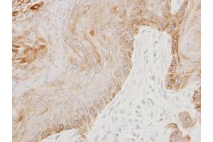 IHC-P Image Immunohistochemical analysis of paraffin-embedded Cal27 xenograft, using GGA3, antibody at 1:100 dilution.