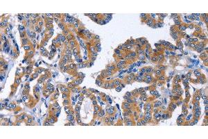 Immunohistochemistry of paraffin-embedded Human thyroid cancer tissue using IGSF10 Polyclonal Antibody at dilution 1:50 (IGSF10 anticorps)
