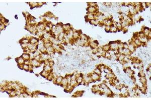 Immunohistochemistry of paraffin-embedded Human thyroid cancer using HMGCS2 Polyclonal Antibody at dilution of 1:100 (40x lens). (HMGCS2 anticorps)