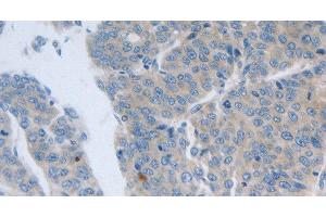 Immunohistochemistry of paraffin-embedded Human liver cancer tissue using GRIN1 Polyclonal Antibody at dilution 1:50 (GRIN1/NMDAR1 anticorps)