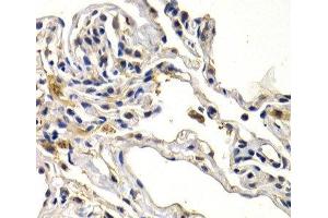 Immunohistochemistry of paraffin-embedded Human lung cancer using WNT3A Polyclonal Antibody at dilution of 1:200 (40x lens). (WNT3A anticorps)
