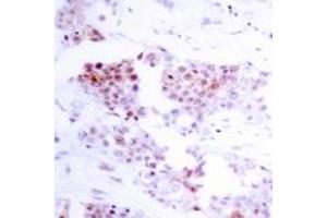 Immunohistochemistry analysis of paraffin-embedded human breast carcinoma tissue, using MEF2A (Ab-319) Antibody. (MEF2A anticorps  (AA 296-345))