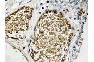 Immunohistochemistry analyzes of FosB antibody in paraffin-embedded human prostate carcinoma tissue. (FOSB anticorps)