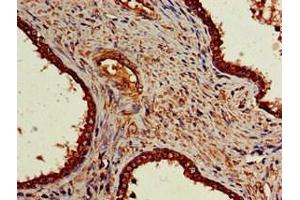 Immunohistochemistry of paraffin-embedded human prostate cancer using ABIN7161911 at dilution of 1:100 (NR5A2 + LRH1 anticorps  (AA 182-291))