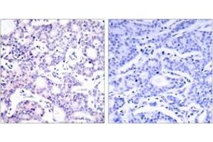 Immunohistochemistry analysis of paraffin-embedded human breast carcinoma tissue, using NF-kappaB p105/p50 (Ab-893) Antibody. (NFKB1 anticorps  (AA 860-909))