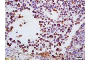 Formalin-fixed and paraffin embedded mouse colon carcinoma labeled with Anti-TdT/DNTT Polyclonal Antibody, Unconjugated (ABIN681973) at 1:200 followed by conjugation to the secondary antibody and DAB staining