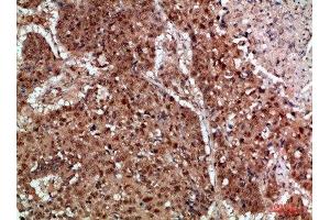Immunohistochemical analysis of paraffin-embedded human-lung-cancer, antibody was diluted at 1:200