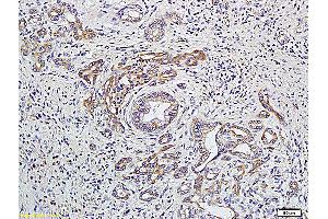Formalin-fixed and paraffin embedded human colon carcinoma labeled with Anti-GNAQ/G? (GNAQ anticorps  (AA 51-150))