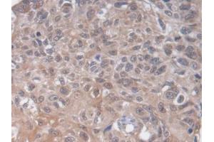 DAB staining on IHC-P; Samples: Human Lung cancer Tissue