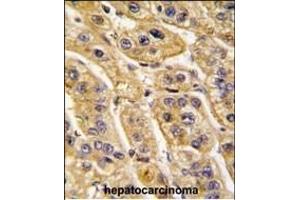 Formalin-fixed and paraffin-embedded human hepatocarcinoma tissue reacted with HIBCH antibody (Center), which was peroxidase-conjugated to the secondary antibody, followed by DAB staining.