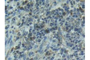 IHC-P analysis of Human Esophagus Cancer Tissue, with DAB staining. (IL1R1 anticorps  (AA 21-109))