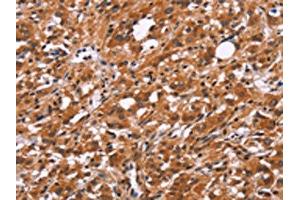 The image on the left is immunohistochemistry of paraffin-embedded Human thyroid cancer tissue using ABIN7192526(SLC8A2 Antibody) at dilution 1/15, on the right is treated with synthetic peptide. (SLC8A2 anticorps)