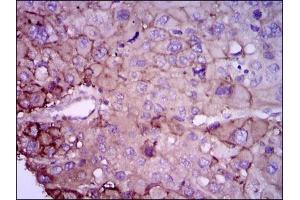 Immunohistochemical analysis of paraffin-embedded liver cancer tissues using RAB4A mouse mAb with DAB staining. (Rab4 anticorps)