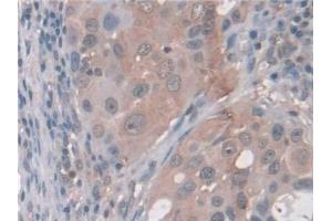 Detection of AASS in Human Breast cancer Tissue using Polyclonal Antibody to Aminoadipate Semialdehyde Synthase (AASS)