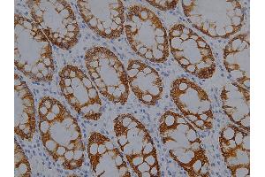 IHC analysis (400X) of CK19 expression in colon cancer, using CK19 antibody (1:1000 dilution).