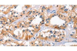 Immunohistochemistry of paraffin-embedded Human thyroid cancer tissue using BNIP3L Polyclonal Antibody at dilution 1:40 (BNIP3L/NIX anticorps)